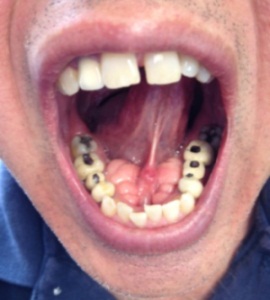 torus teeth