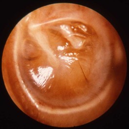 ear-infection-glue-ear