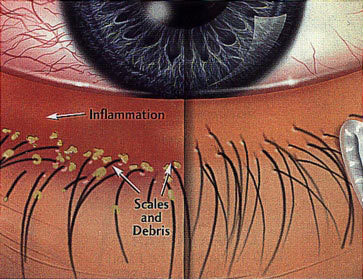 blepharitis-eye-infection