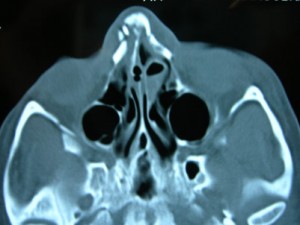 broken-nose-CT-scan