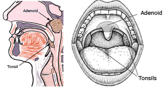 adenoidectomy before and after