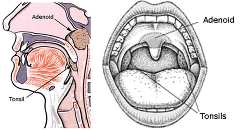 Adenoid Nose