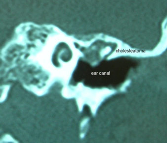 CT-scan-petrous-temporal-bones-cholesteatoma