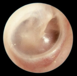 Normal eardrum