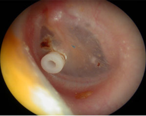 Children's ear grommet surgery
