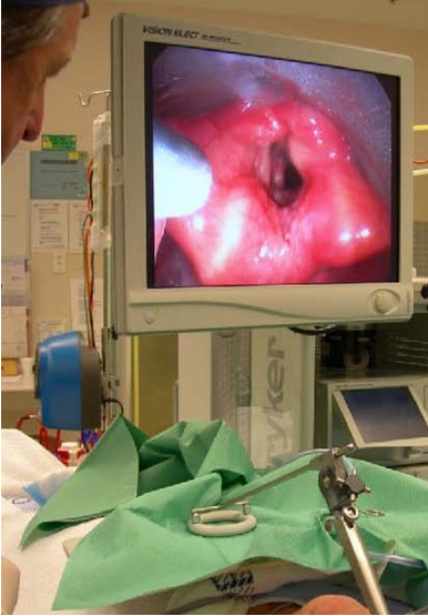 laser-laryngeal-microsurgery-Sydney