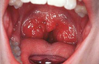 tonsil-and-adenoid-surgery-chronic-tonsillitis