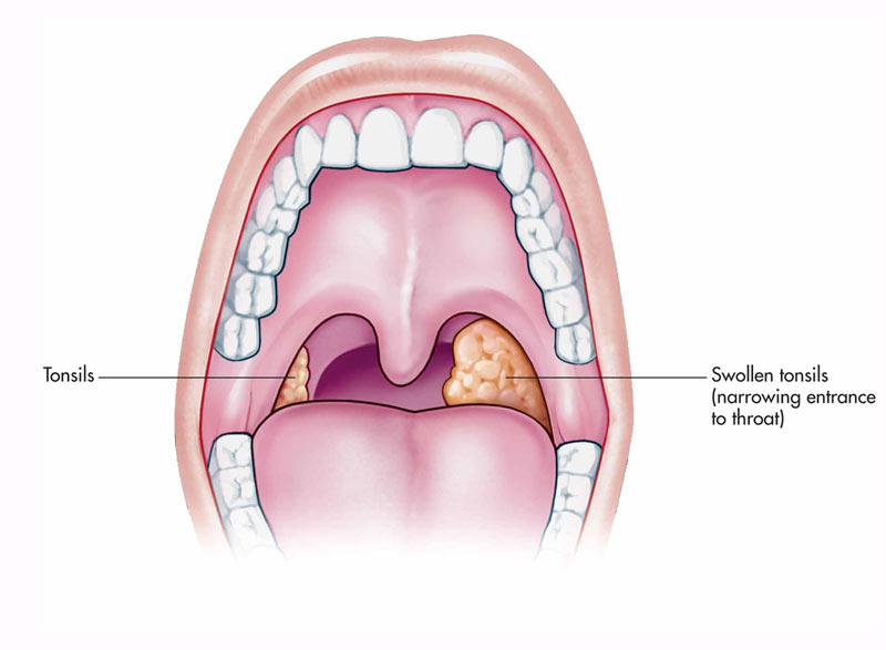 Treatment of tonsillitis for people with elevated liver enzymes