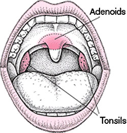 tonsils-and-adenoid-removal
