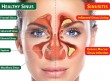 sinus-surgery-for-patients-with-allergy