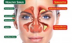 sinus-surgery-for-patients-with-allergy