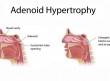 adenotonsillar-hypertrophy-correlation-between-obstruction-types-and-cardiopulmonary-complications