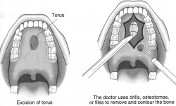 mandibular-torus