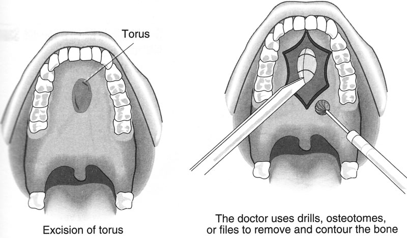 mandibular-torus