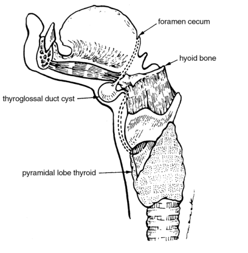 thyroglossal-duct-cyst