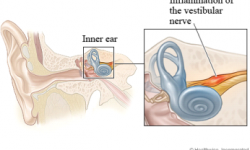 vestibular-neuronitis