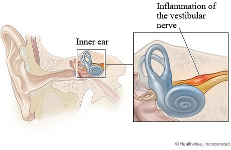 vestibular-neuronitis