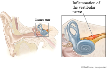 vestibular-neuronitis