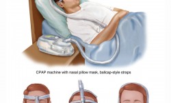 sleep-apnea-tied-increased-cancer-risk