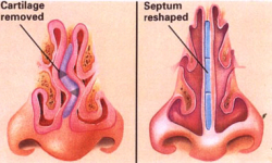 septoplasty-turbinate-reduction-surgery