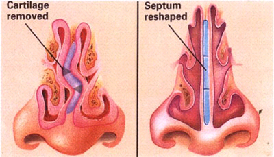 septoplasty-turbinate-reduction-surgery