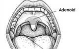 tonsil-adenoid_thumb