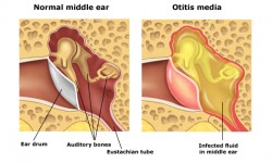 acute-otitis-media-ear-infection