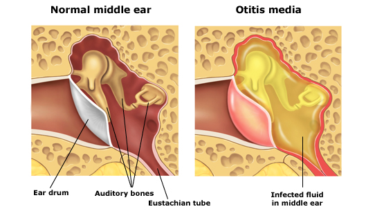 Oído medio normal (a la izquierda) y otitis media (a la derecha)