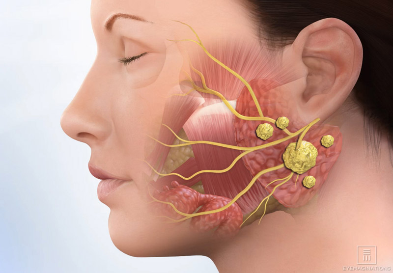 submandibular gland swelling home remedies