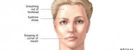 what-causes-bells-palsy