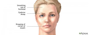 What Causes Bell’s Palsy? - ENT Clinic Sydney