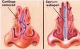 septoplasty-turbinate-reduction-surgery_thumb