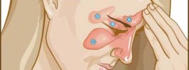 sinusitis-1