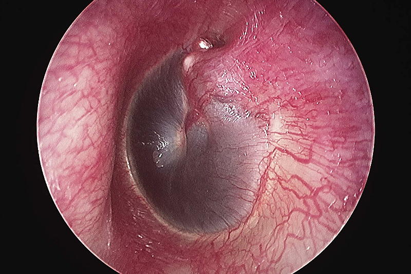 Small amounts of blood in ear canal?